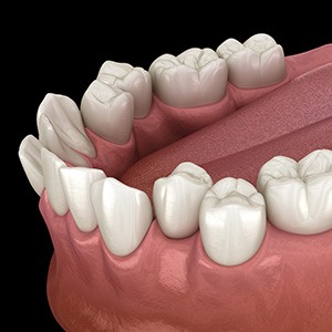 Illustration of a row of crowded teeth
