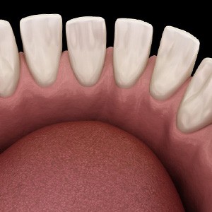 Illustration of gapped teeth