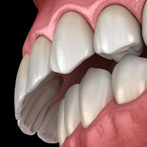 Illustrated mouth with an overbite
