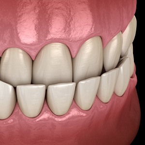 Illustrated mouth with an underbite