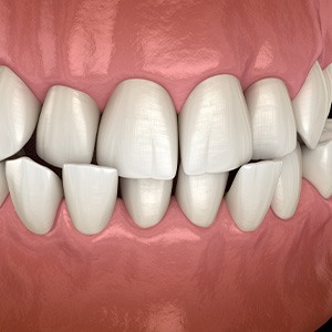 Illustrated mouth with a crossbite