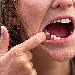 Close-up of a mouth with a missing tooth