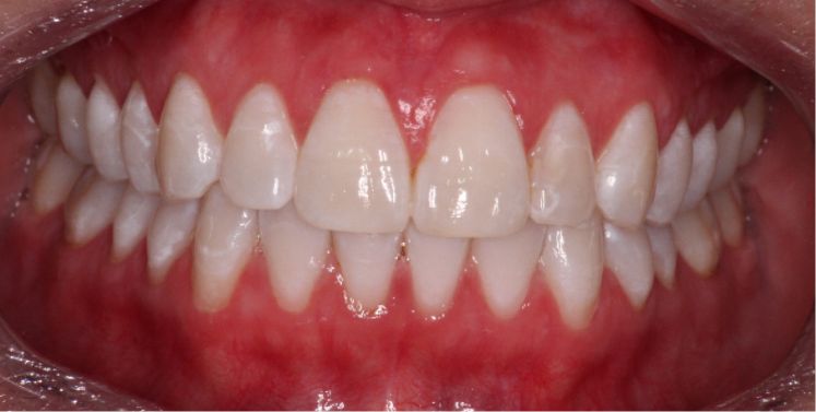 Close up of a smile with whiter teeth after treatment from a Wilmington dentist