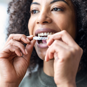 Woman putting an Invisalign clear aligner over her teeth