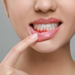 Woman pointing to her inflamed gums