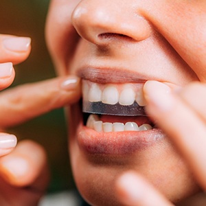 Closeup of patient putting on whitening strip