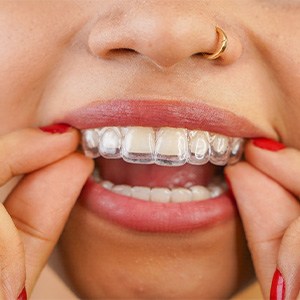 Woman putting in her clear aligners