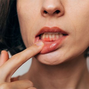 Woman with gum irritation