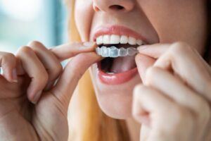 Woman fitting clear aligner onto teeth. 
