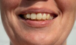 Close-up of slightly yellow teeth.